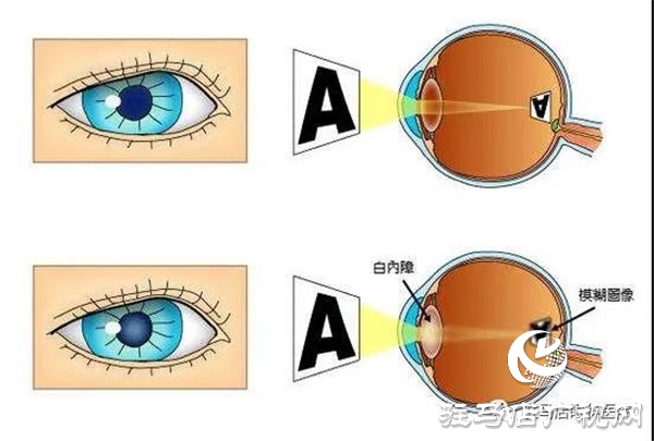  6·6愛(ài)眼日 | 關(guān)注普遍眼健康