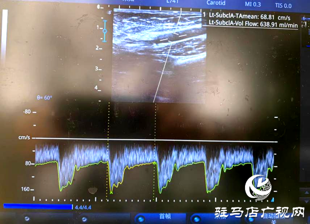 市內(nèi)首例!內(nèi)瘺上臂段覆膜支架植入打通透析“生命線”