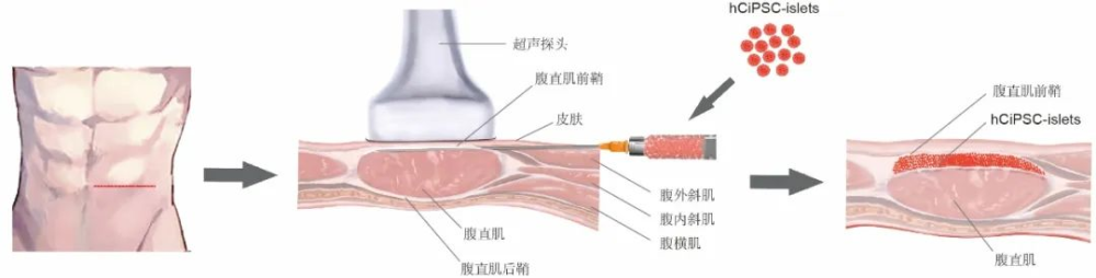 事關(guān)糖尿病治療，我國(guó)科學(xué)家取得突破